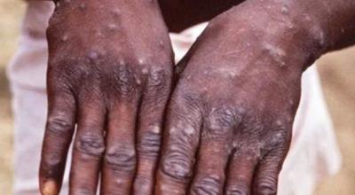 Covid, monkeypox poses formidable challenge to world: WHO