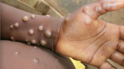 US confirms nine monkeypox cases