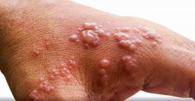 Monkeypox: San Francisco declares state emergency